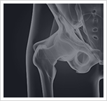 Hip Injury Image