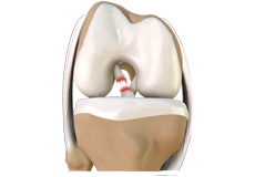 Anterior Cruciate Ligament (ACL) Tears