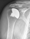 shoulder arthritis