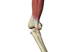 Bicep Tendon Rupture