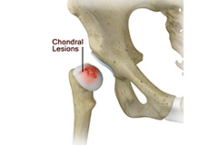 Chondral (Articular Cartilage Defects)