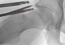 Hip Arthroscopy