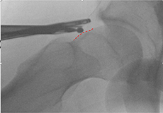 Hip Arthroscopy