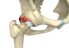 Femoroacetabular Impingement