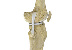 Lateral Collateral Ligament (LCL) Reconstruction