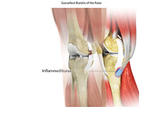 Medial Collateral Ligament (MCL)Tears