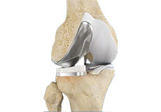 Partial Knee Replacement