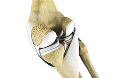 Posterior Cruciate Ligament (PCL) Injury