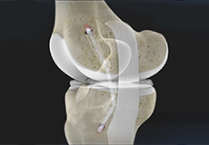 Posterior Cruciate Ligament (PCL) Reconstruction