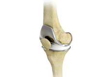 Total Knee Replacement