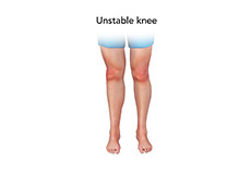 Unstable Knee